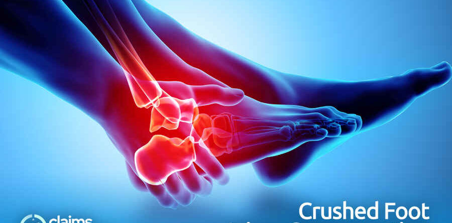 Crushed Foot Injury Compensation
